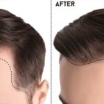 Best Hair Transplant in Islamabad