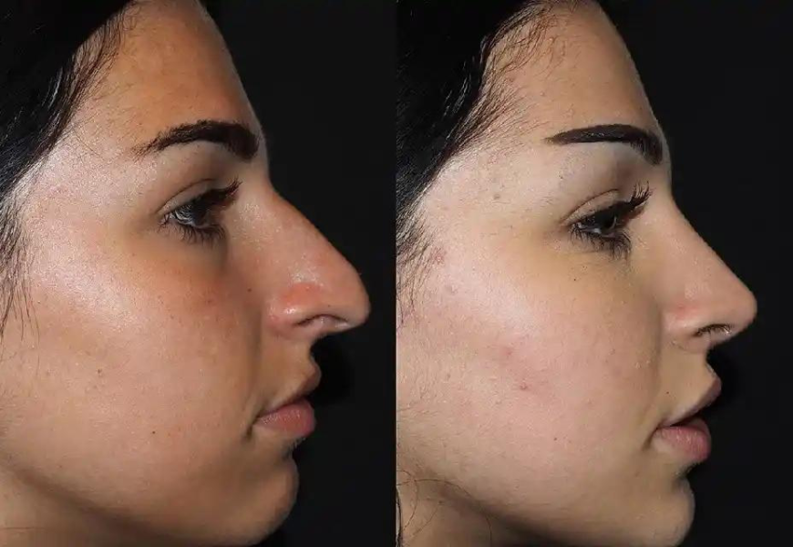 Teen Rhinoplasty: Is It Safe? Insights on Dubai Options